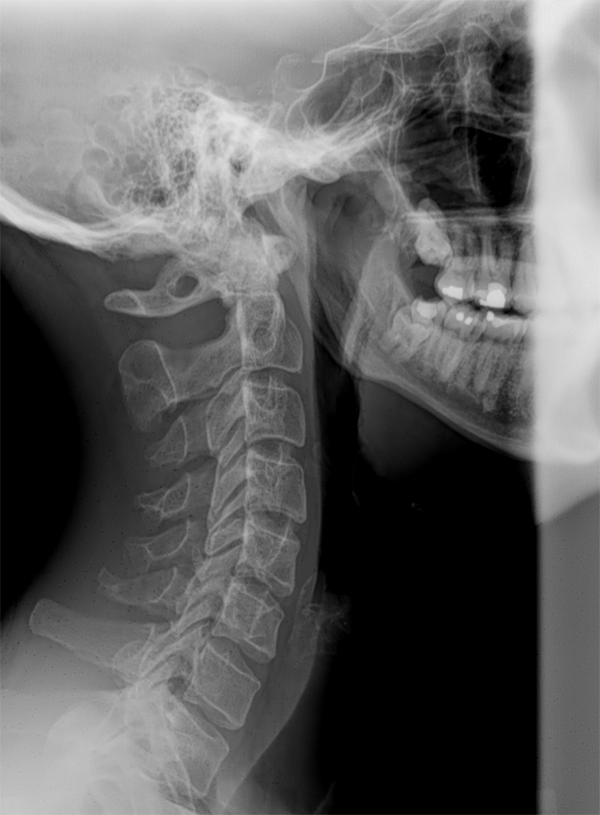 neck-x-ray.png